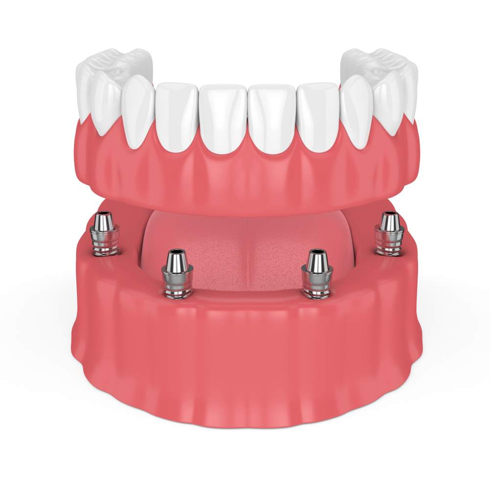 3d,Render,Of,Removable,Full,Implant,Denture,Isolated,Over,White