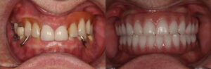 reno-tahoe_before-and-after_implant-supported-dentures_0000_patient-1a