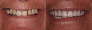 reno-tahoe_before-and-after_implant-supported-dentures_0001_patient-1b