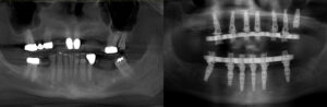 reno-tahoe_before-and-after_implant-supported-dentures_0002_patient-1c